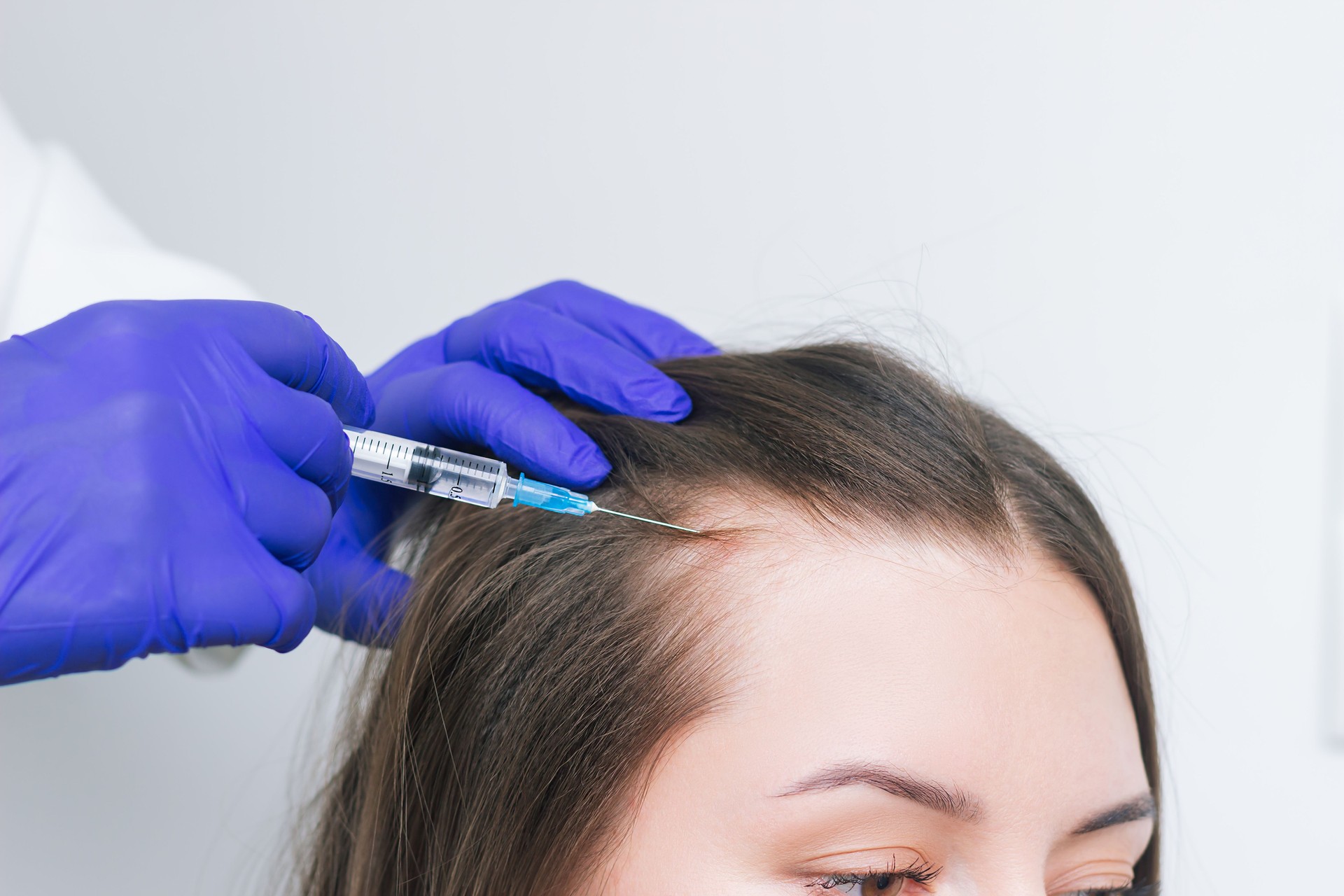 A young woman suffering for hair loss receiving injections into the scalp for hair growth. PRP therapy for hair Loss. Mesotherapy for hair growth.